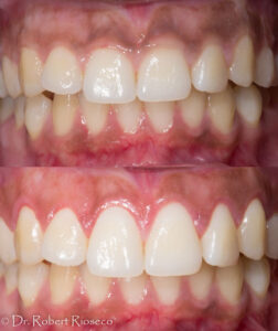 Laser Gum Lift And Contouring - Westlake Smile Studio