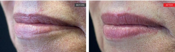 Lips rejuvenation and volume restoration with fillers and laser -  CosmoBeats Center